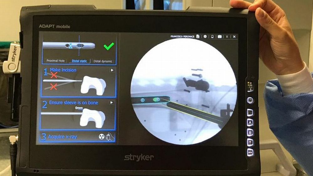 Frattura del femore: nuova tecnologia in Ortopedia al Santo Spirito di Casale Monferrato