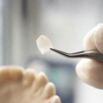 Faccette dentali a Torino: guida alla scelta consapevole