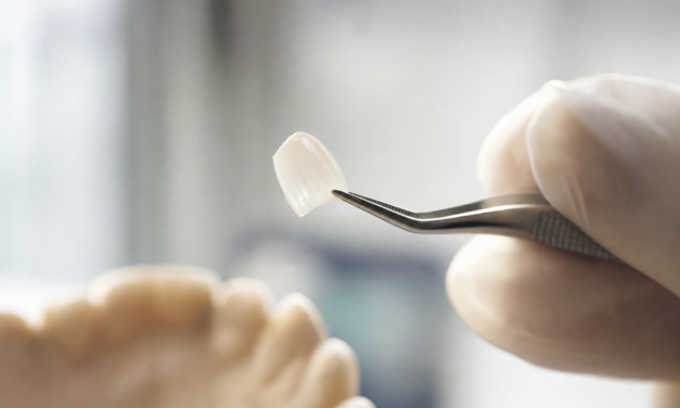 Faccette dentali a Torino: guida alla scelta consapevole